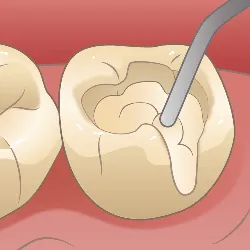 硬質レジン前装冠(前歯の治療 )