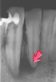 ウミの袋ができた状態
