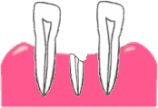 1.歯の根の部分だけが残っている状態。